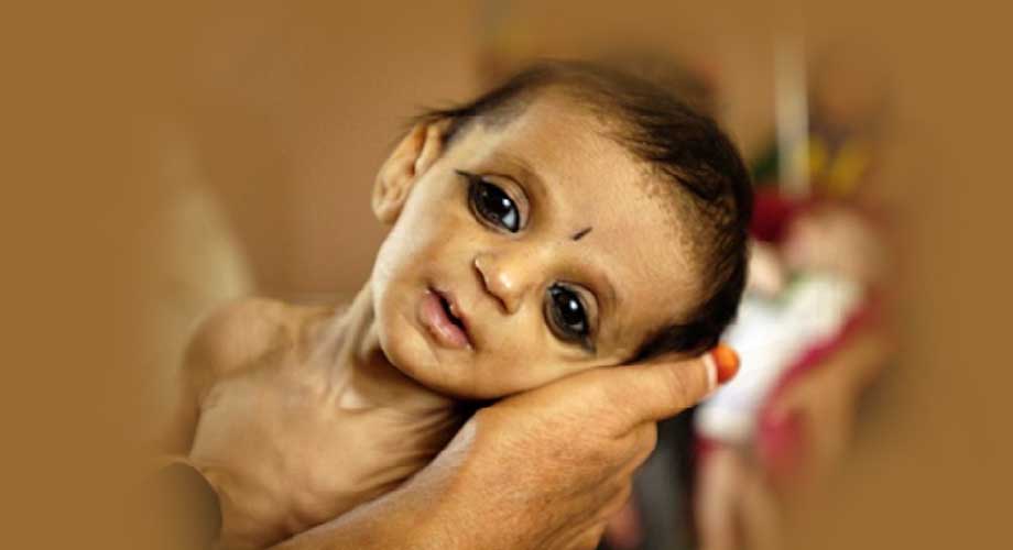चार प्रतिशत बालबालिकामा भेटियो कुपोषण, कुन-कुन प्रदेशमा बढी जोखिम?